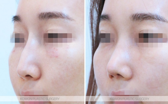 What Is Refined Natural Nose Surgery? Check This If You’re Considering Small Nose Surgery image 4