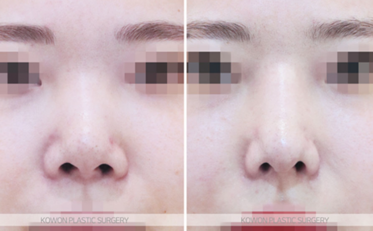 Q. Is a change in nose surgery silicone a case that requires revision surgery? image 7