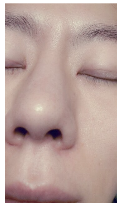 Q. My nose looks artificial because of swelling after bulbous nose surgery. Should I get revision rhinoplasty? image 4
