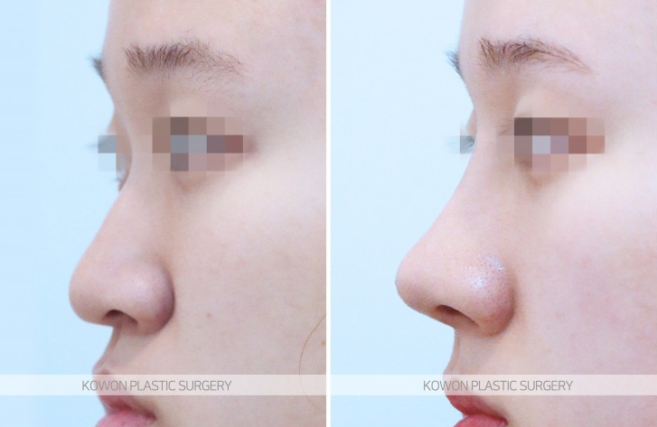 Q. It seems like swelling from low-nose surgery—would it be better to remove the silicone? image 5