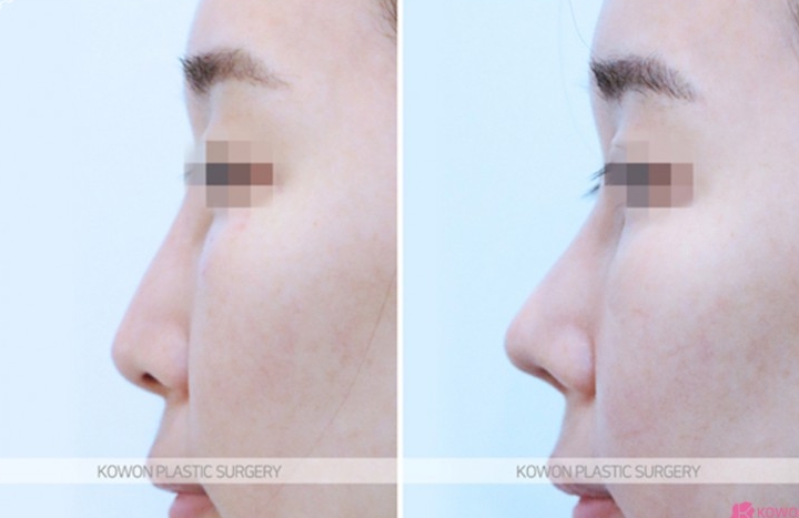 Q. Nasal Surgery Swelling: Is the Swelling on the Bridge of the Nose Due to Infection After Nose Surgery? image 6