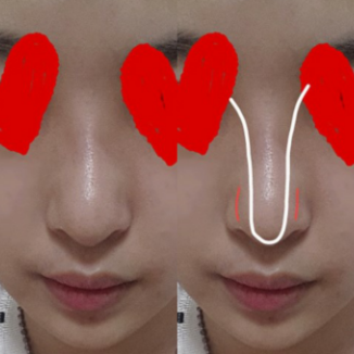 Q. After surgery on the nasal tip and bridge, I think my nose has become an arrow nose image 3