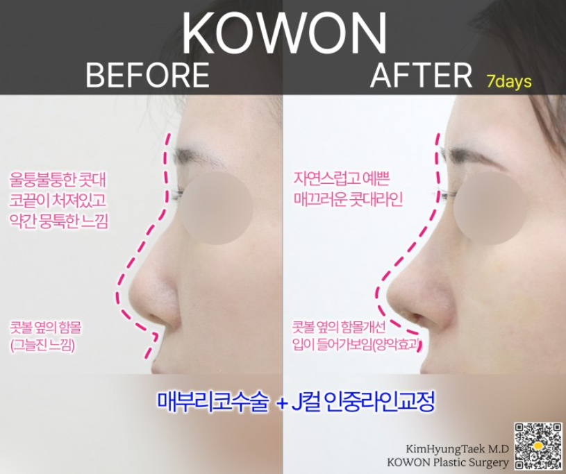 매부리코성형 전후 얼마나 차이날까? 복코와 넓은 콧볼까지 함께 고려한 변화 관련 이미지 4