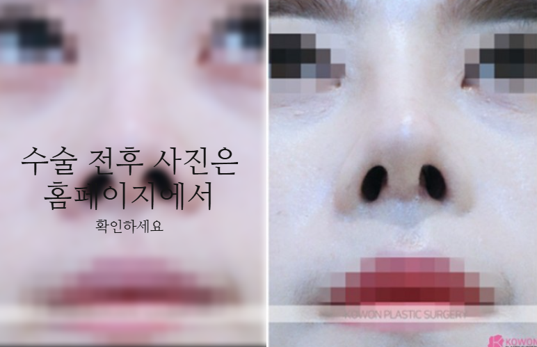 작은코성형에서 입체감 있는 코 라인을 만드는 핵심 3가지 관련 이미지 8