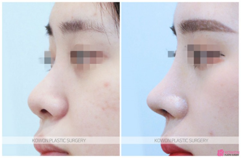 Before-and-After Differences in Bulbous Nose Tip Surgery! The Importance of Proportion and Structure Found at 코원성형외과 image 3