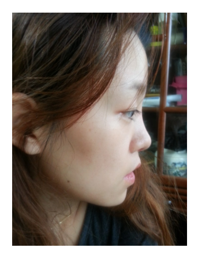 Q. 비중격코수술 후 불편한 느낌, 부작용인가요? 관련 이미지 3