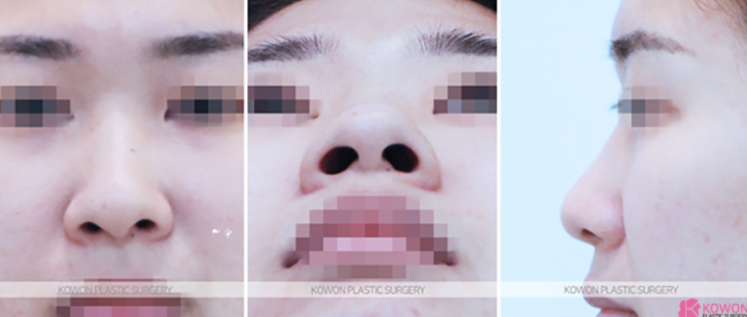 Q. Learn About Changes Before and After Alar Reduction Surgery Without Implants and Alar Reduction Surgical Methods image 4