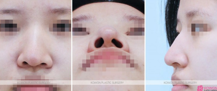 Q. Is drinking and smoking okay one month after nose surgery? A summary of nose-tip pulling symptoms and 기준 image 3