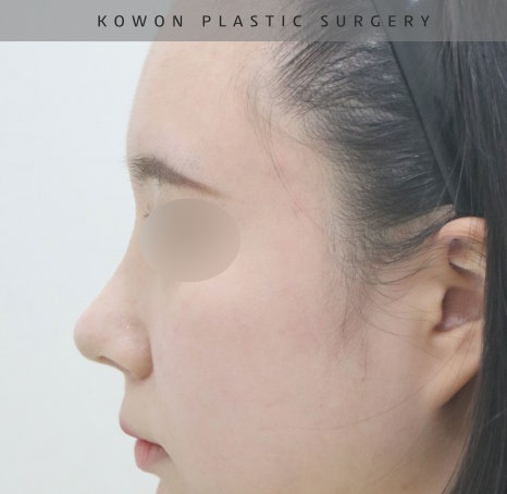 I Was Reborn with Small, Bulbous Nose Correction and Functional Nose Surgery for Deviated Septum at Kowon Plastic Surgery image 12