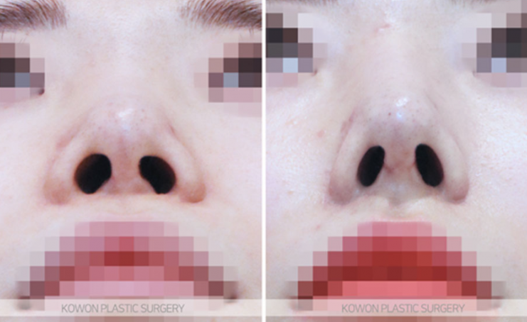 Q. Is a change in nose surgery silicone a case that requires revision surgery? image 8