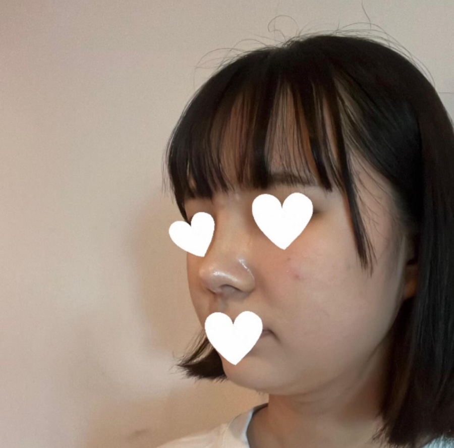 I Was Reborn with Small, Bulbous Nose Correction and Functional Nose Surgery for Deviated Septum at Kowon Plastic Surgery image 6