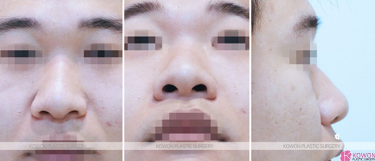 Q. Cartilage Pain After Nose Surgery: Is It a Side Effect of Male Rhinoplasty? Causes and How to Handle It image 5