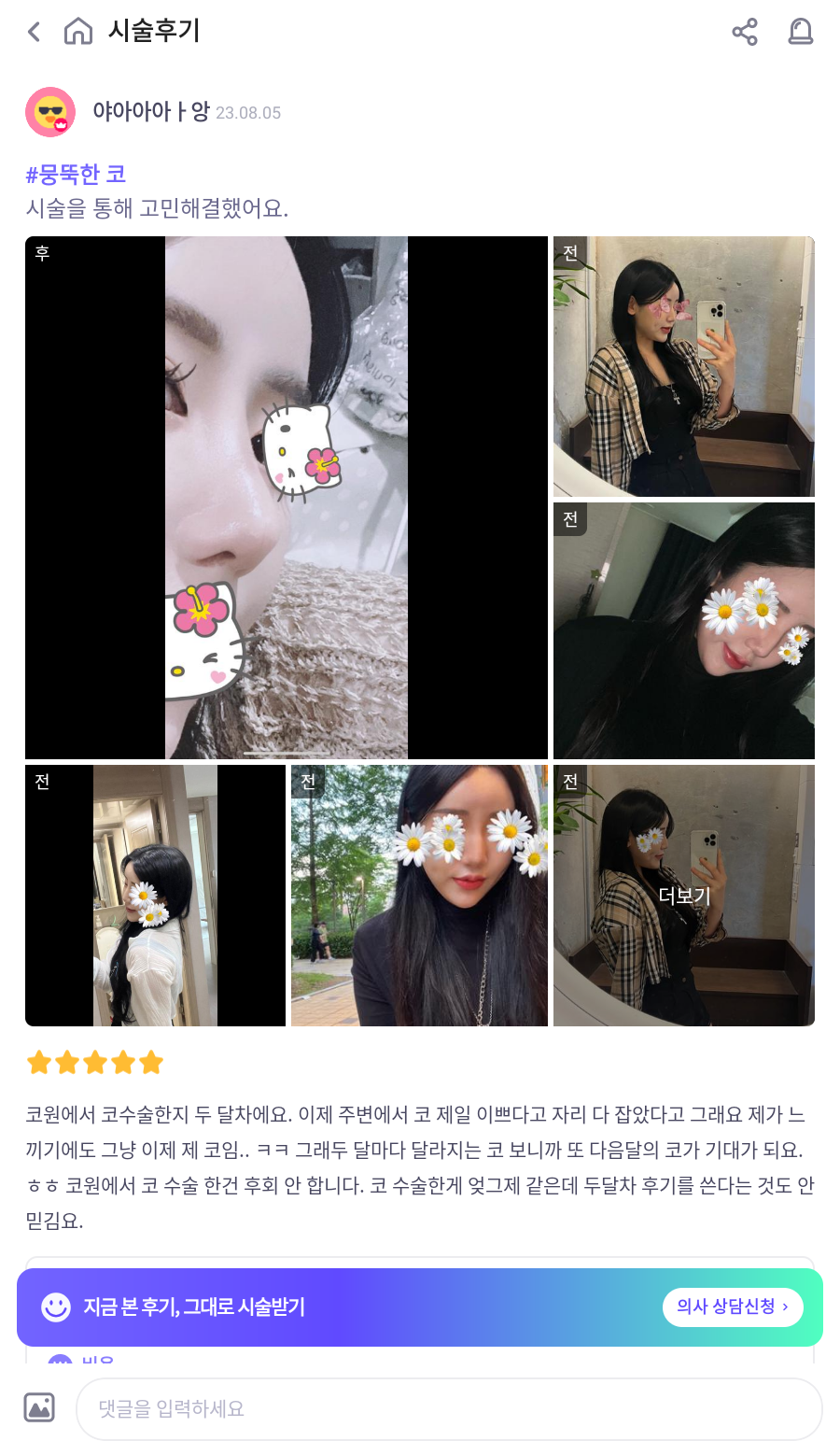 울퉁불퉁해 신경 쓰이던 코를 코원성형외과에서 낮은코와 매부리코교정으로 매끄럽게 만들었어요! 관련 이미지 10