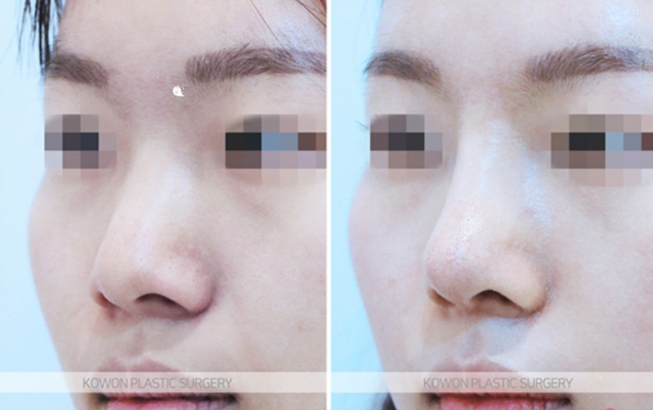 Q. How much swelling is there one month after nose surgery? Questions before rhinoplasty image 7