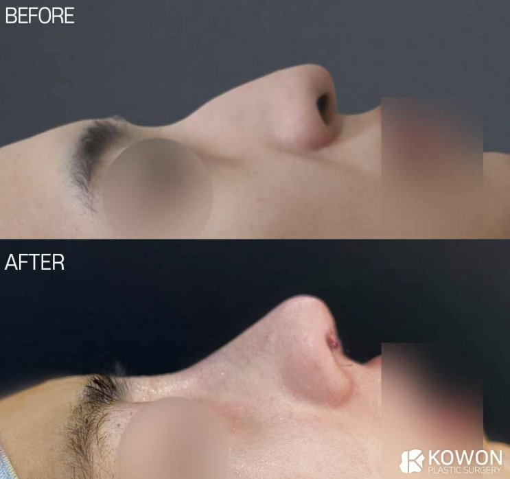 How Much Does a Man’s Hump Nose Surgery Change Your Appearance? Before-and-After Changes and Recovery Time Summary image 2