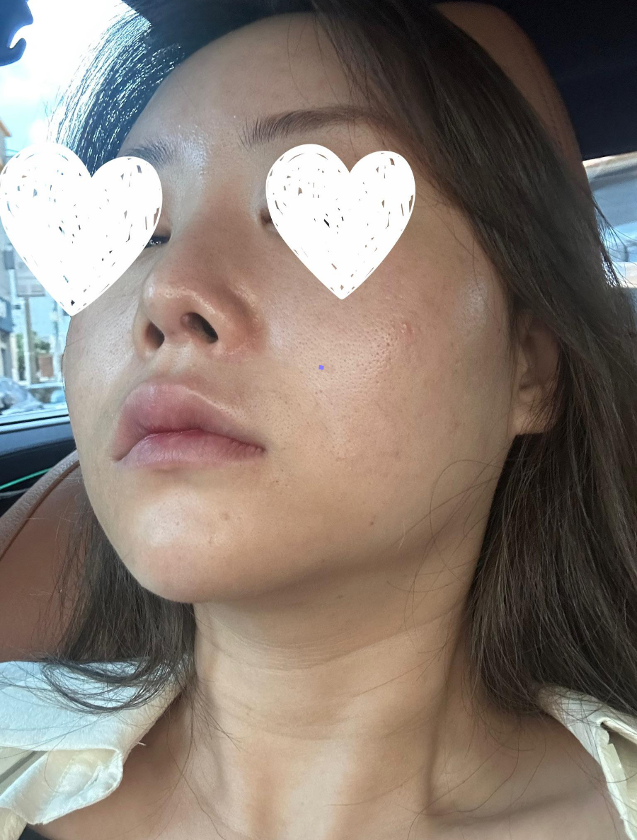 Revision Rhinoplasty Using Autologous Rib Cartilage, I Resolved My Concerns Through Surgery! image 2