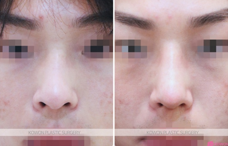 Q. Nasal Bone Fracture Rhinoplasty: Can I Correct a Crooked Nose and Raise the Bridge Even Though It’s Broken? image 5