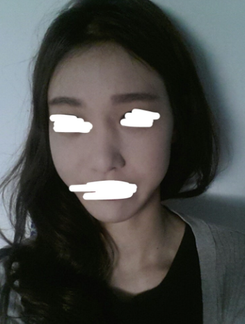 Q. 넓은 콧등뼈 절골술, 얼굴 더 길어 보일까요? 관련 이미지 3