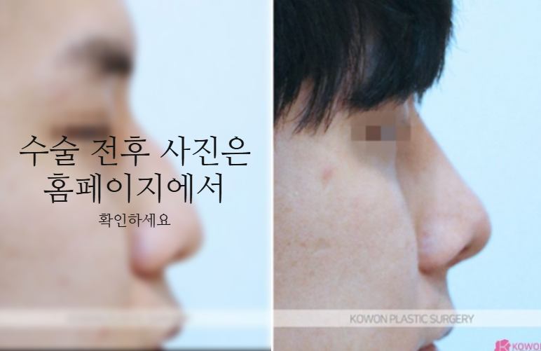 The Recovery Period After Deviated Septum Surgery and 3 Key Factors Determining Male Nose Balance image 10