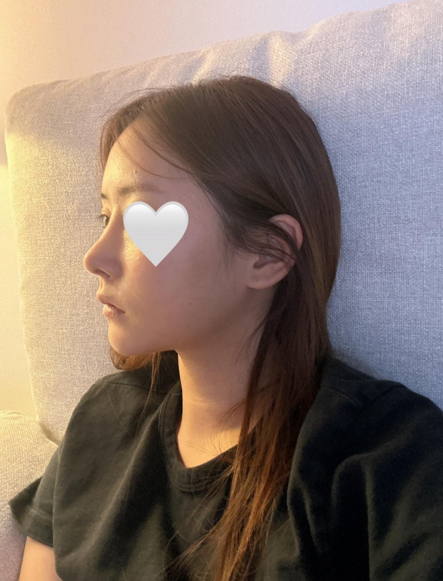Revision Rhinoplasty Using Autologous Rib Cartilage, I Resolved My Concerns Through Surgery! image 4