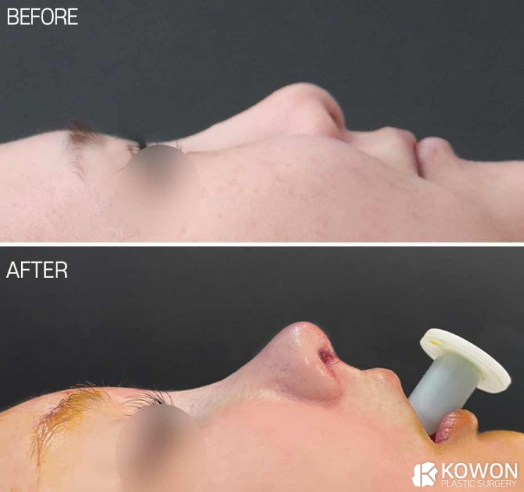 [Cowon Plastic Surgery] Refining a spread, bulbous nasal tip and flat nasal bridge at once! A natural-yet-glamorous line completed with bulbous nasal tip surgery image 2