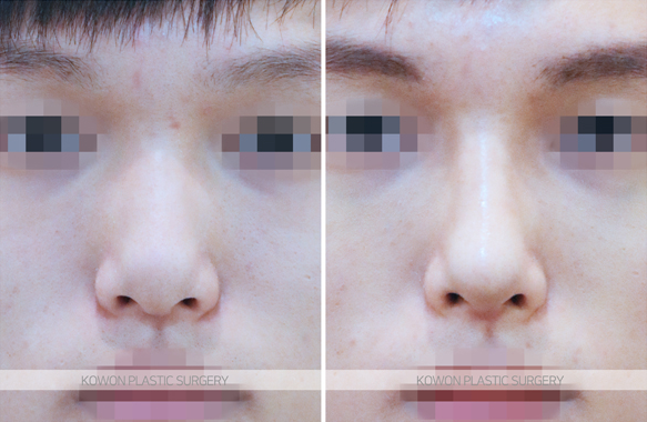 Q. I bumped my nose after nose surgery. It’s been over a year since the operation—will it be okay? image 3