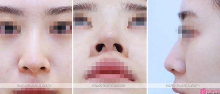 복코코끝성형 전후, 퍼진 코끝과 둔한 콧대 개선 과정 알아봐요 관련 이미지 4