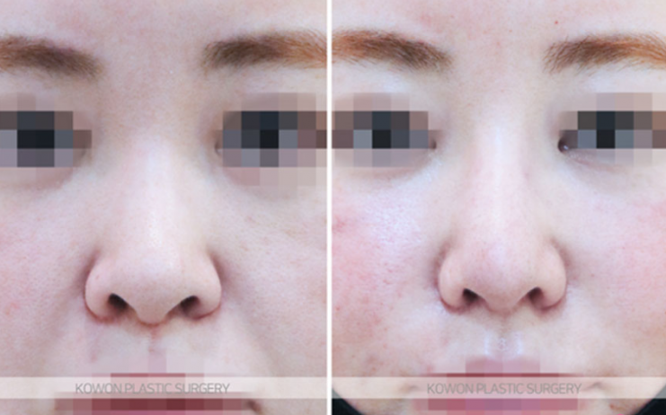 Q. I’m wondering whether my nose surgery swelling period needs more time to look natural, or whether revision surgery is necessary. image 3