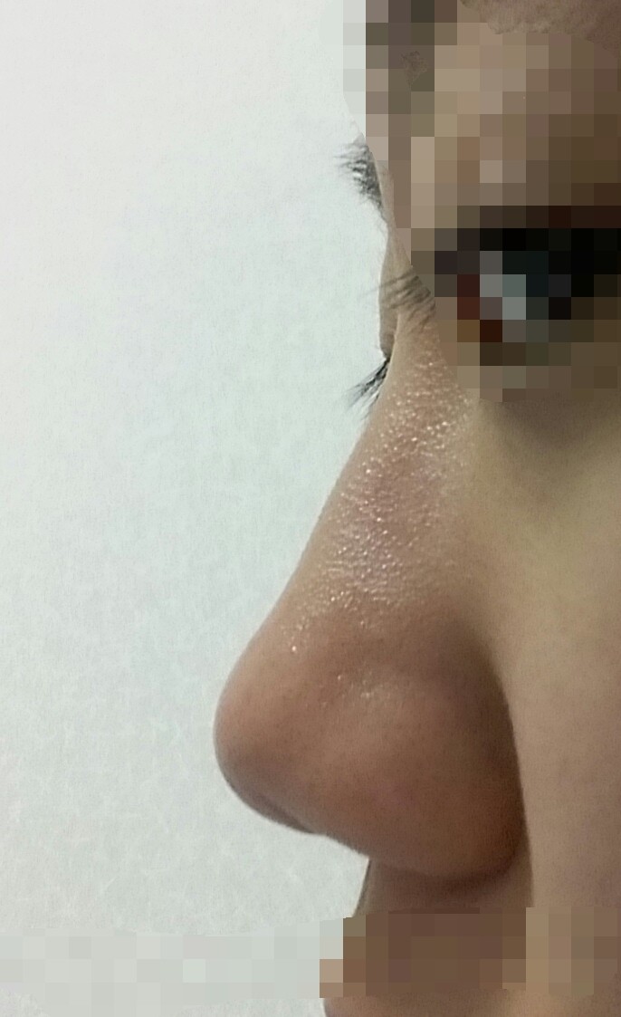Q. I’m planning to get a nose job—please tell me the types of rhinoplasty (bulbous nose surgery) image 5
