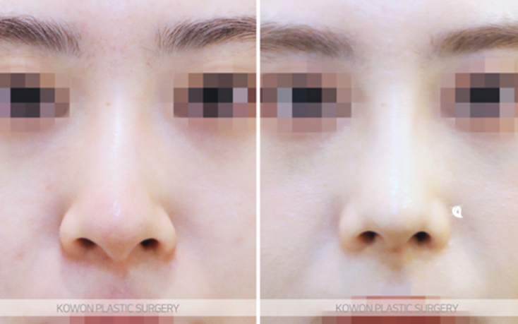 Q. Worried About Crooked Nose Surgery, What Nose Surgery Direction Should Be Considered Before Double Jaw Surgery image 8