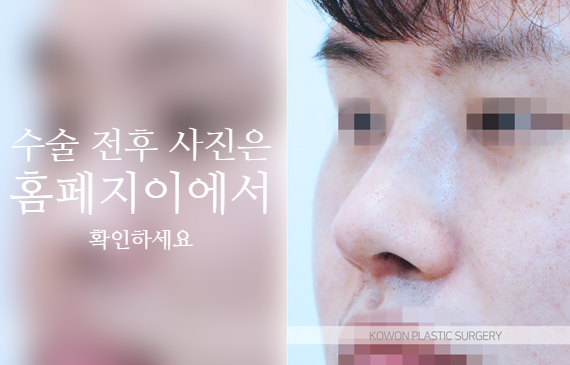 남자복코수술 매부리코와 콧볼을 함께 교정해야 자연스러운 이유 관련 이미지 6