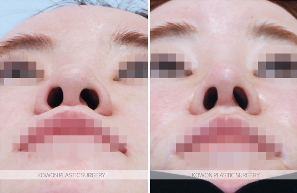 Q. Nasal Surgery Inflammation: Is Gore-Tex Implants with Ear Cartilage at the Tip Okay? image 3
