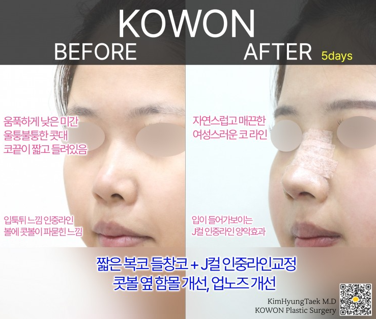 Q. My nose became a hooked nose after nose surgery.. What kind of revision surgery would be needed? image 7