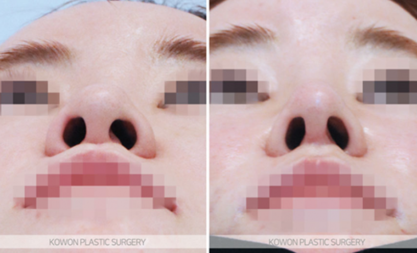 Natural Nose Line Improvement Process Seen Through Changes Before and After Cartilage Stitching at the Nasal Tip image 6