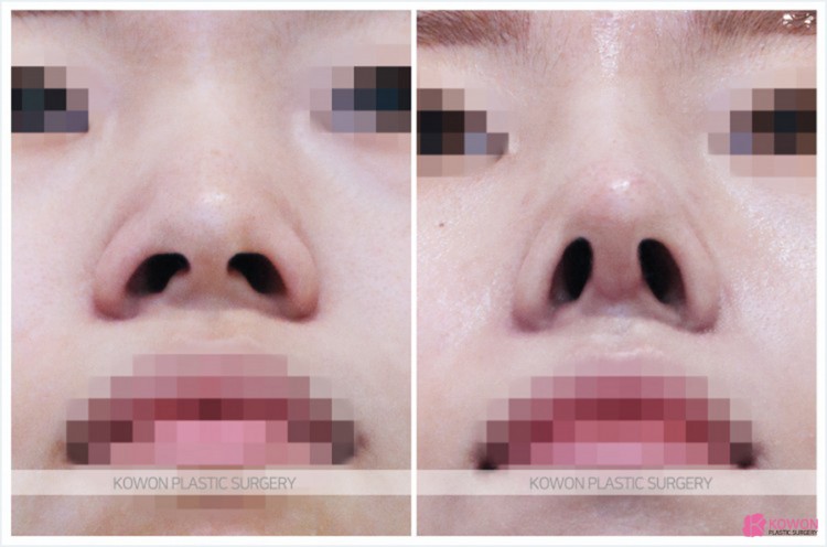 Q. 코수술 후 코안 점막 부음(코수술부작용)일까요? 관련 이미지 4