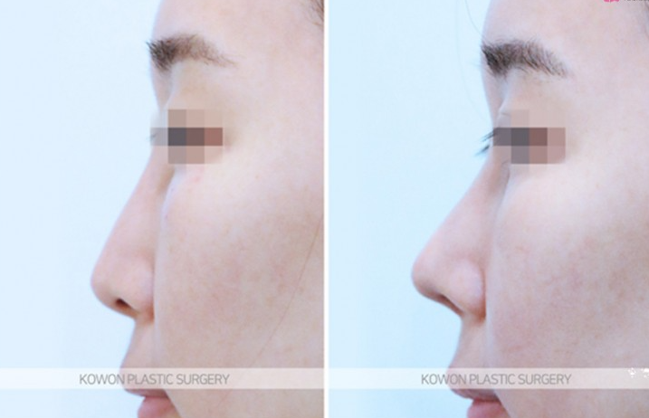 Q. Considering Surgery for the Bridge Between the Eyebrows and the Nose: Side Effects of Nasal Bridge Surgery and Key Points for Revision Surgery image 7