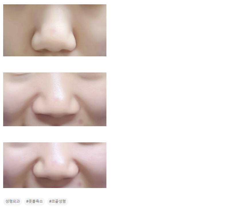 Q. 코끝이 뭉툭하고 웃을 때 퍼진코가 심해져요.. 관련 이미지 3