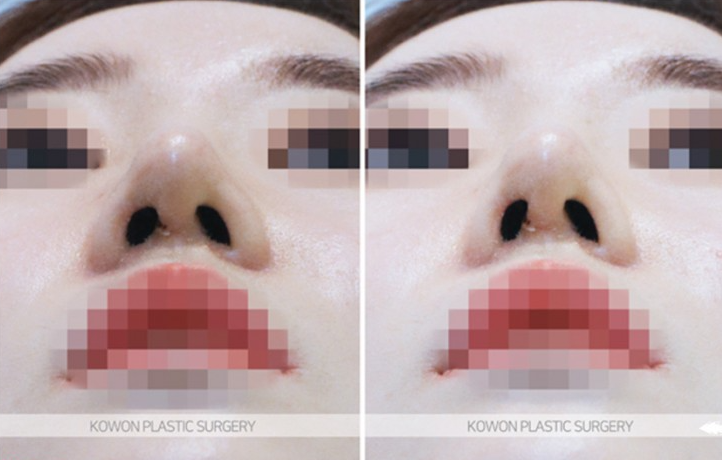 Q. Is Kangnam nose revision surgery necessary for a nose tip surgery complication? image 10