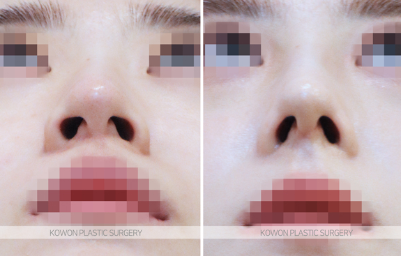 휜코성형 하면 복코도 함께 개선되나요? 비대칭 변화 과정 정리 관련 이미지 7