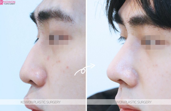 Q. Concerns After Hump Nose Rhinoplasty and Nasal Fracture Surgery: Possibility of Revision Surgery for Men image 9