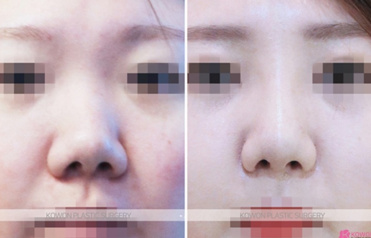 Q. 기증늑연골로 수술했는데 코끝 들림 들창코 같아 보여요. 관련 이미지 5