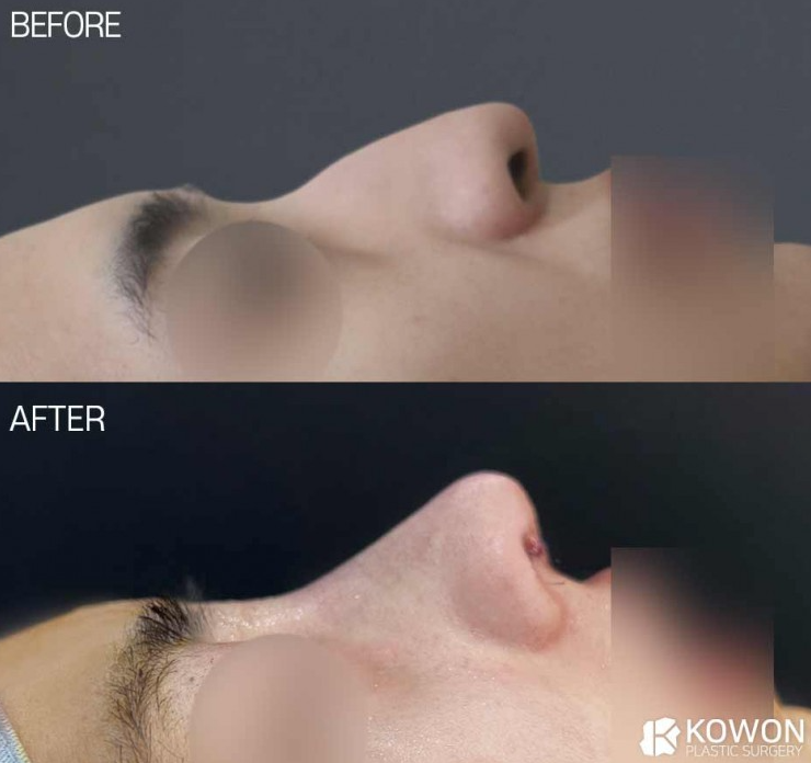 What Are the Criteria for Choosing a Good Place for Men’s Rhinoplasty? A Summary of Changes Before and After a Hump Nose Correction image 3