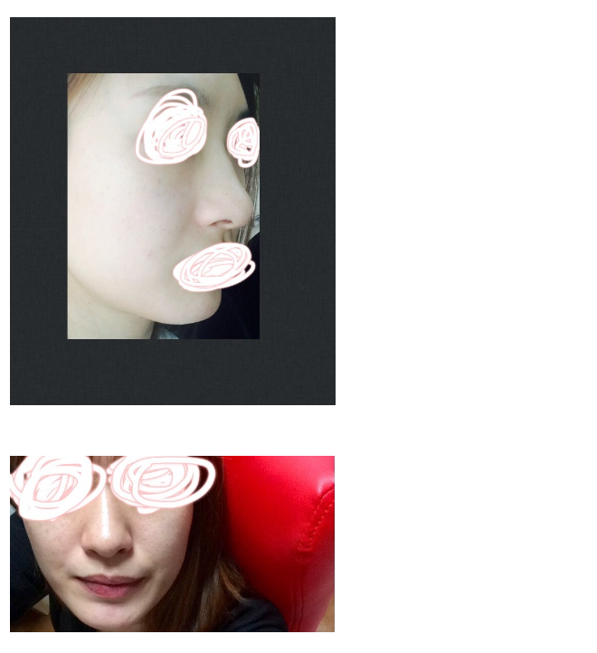 Q. Should a Hump Nose Be Improved with the Septum? image 3