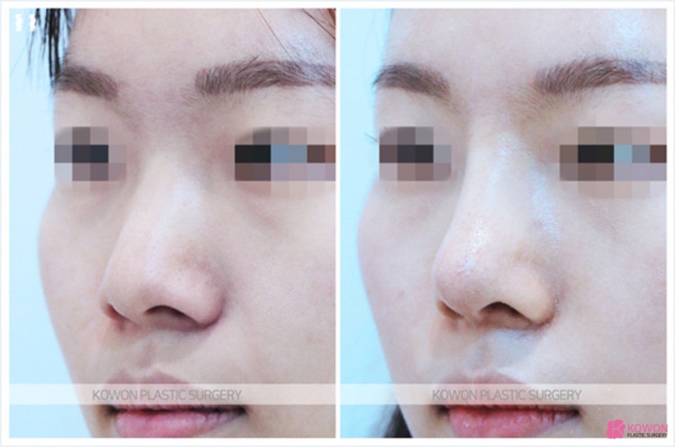 Q. 코수술 후 코안 점막 부음(코수술부작용)일까요? 관련 이미지 5