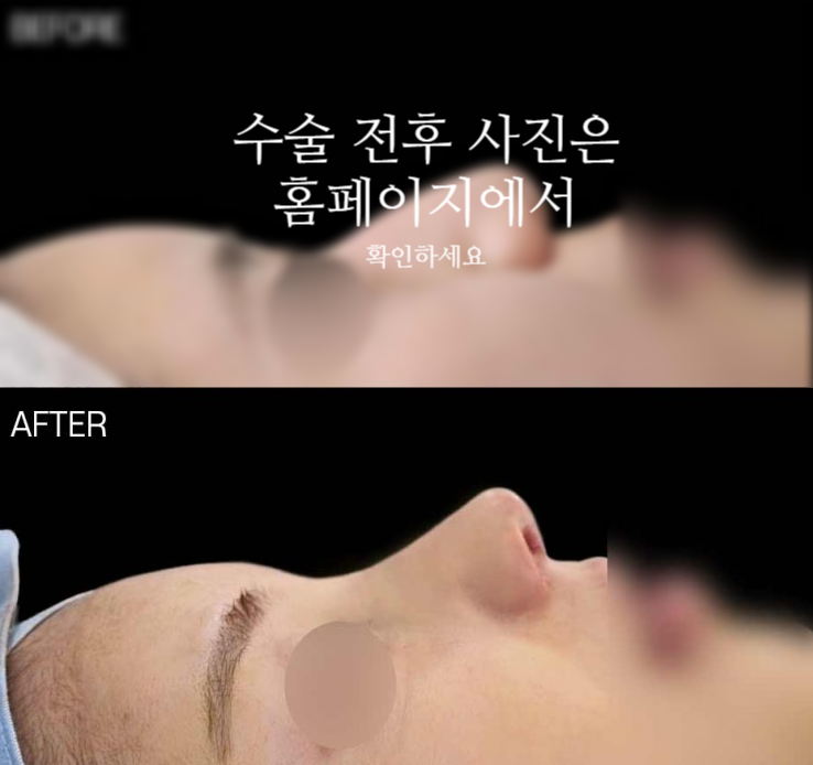비순각교정 VS 단순 코높임 차이점과 회복에 대하여 관련 이미지 2