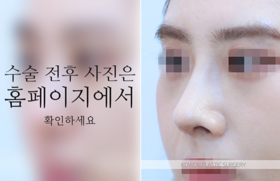 코끝연골재배치 자연스러운 자려한 코를 만드는 3가지 포인트 관련 이미지 5