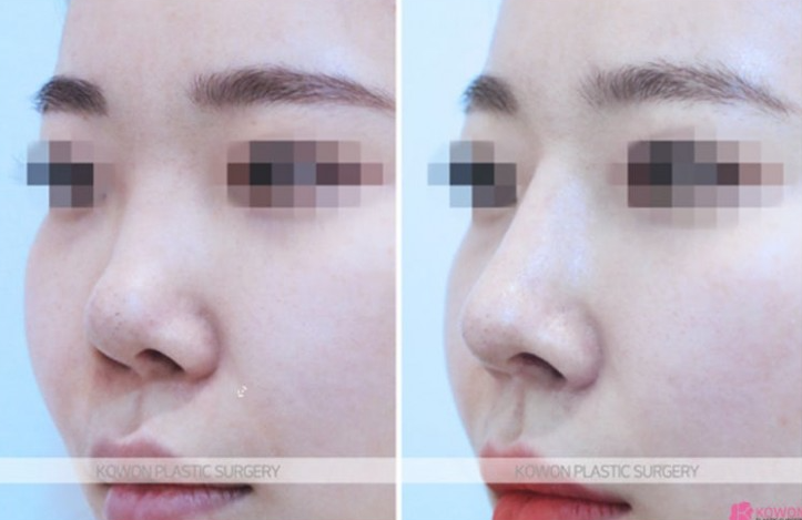 Q. I’m 고민 whether this is a side effect of cartilage nose surgery after revision rhinoplasty near Sinsa Station image 9