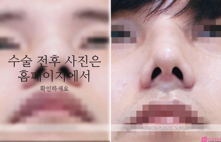 The Recovery Period After Deviated Septum Surgery and 3 Key Factors Determining Male Nose Balance image 9