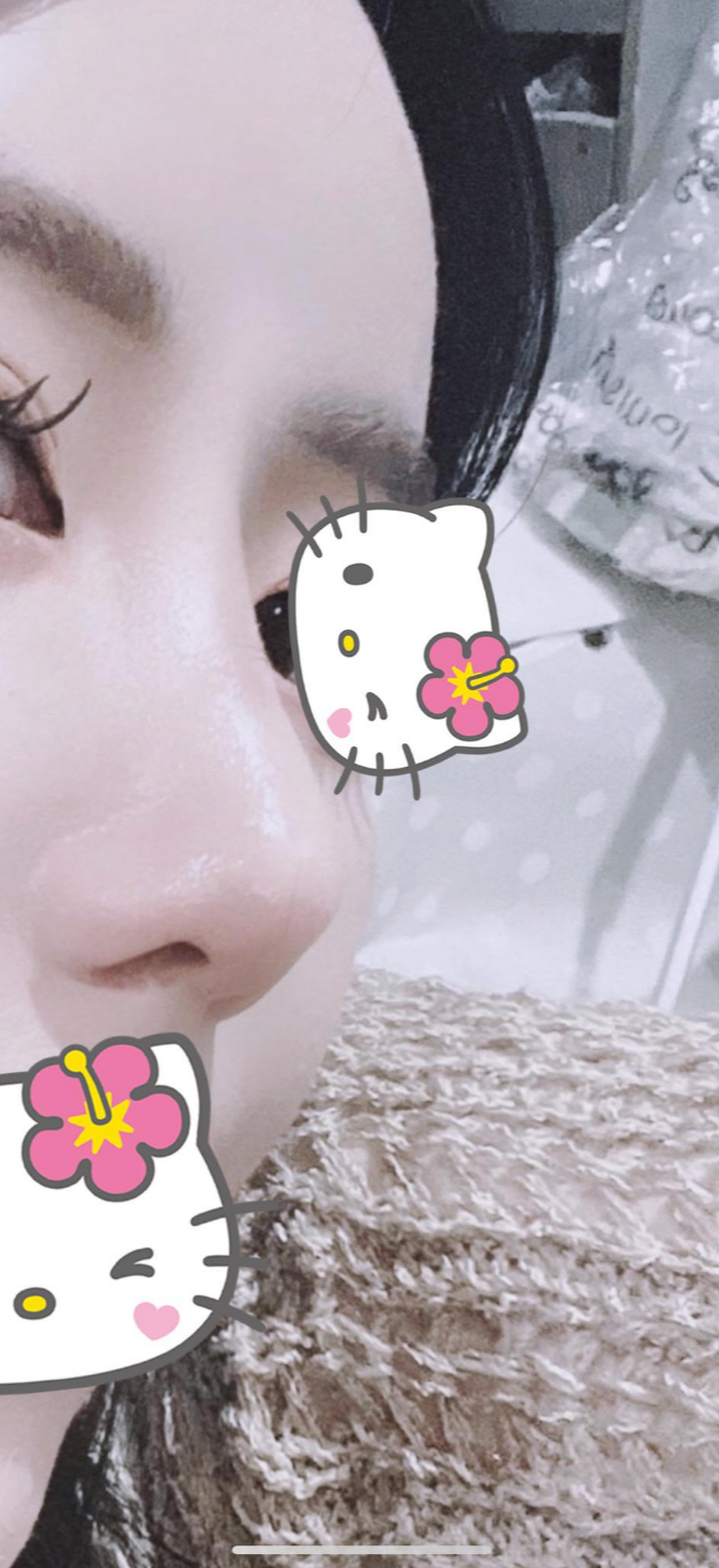 울퉁불퉁해 신경 쓰이던 코를 코원성형외과에서 낮은코와 매부리코교정으로 매끄럽게 만들었어요! 관련 이미지 6