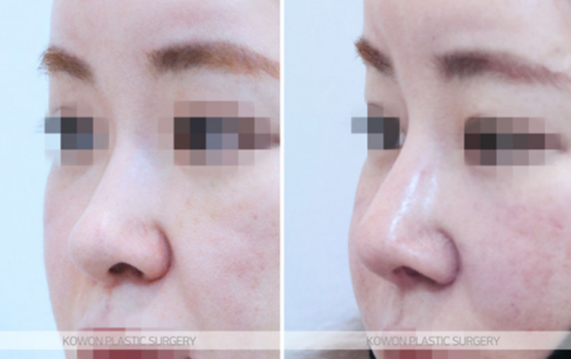 Natural Nose Line Improvement Process Seen Through Changes Before and After Cartilage Stitching at the Nasal Tip image 8